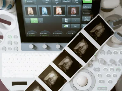Console ecografica 4D con modalità di rendering HDlive e strip stampata