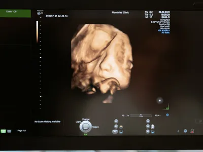 Ecografia 3D del volto fetale sul monitor